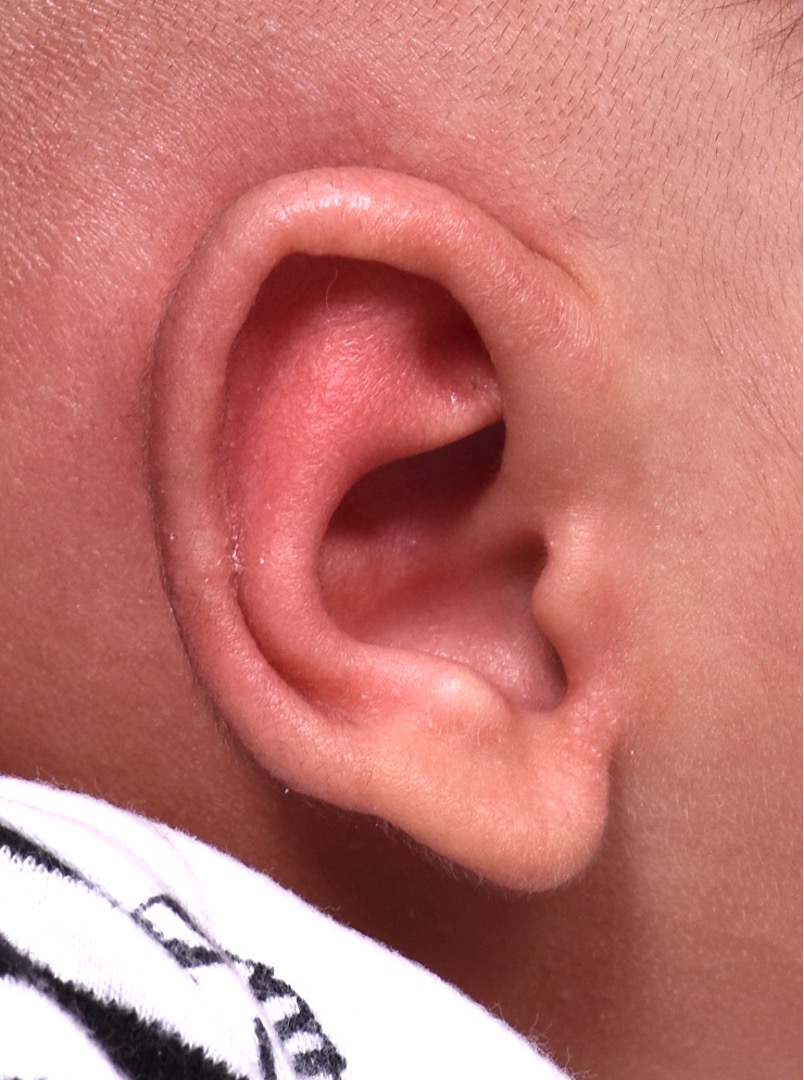 Newborn baby ear correction Atlanta before and after Earwell