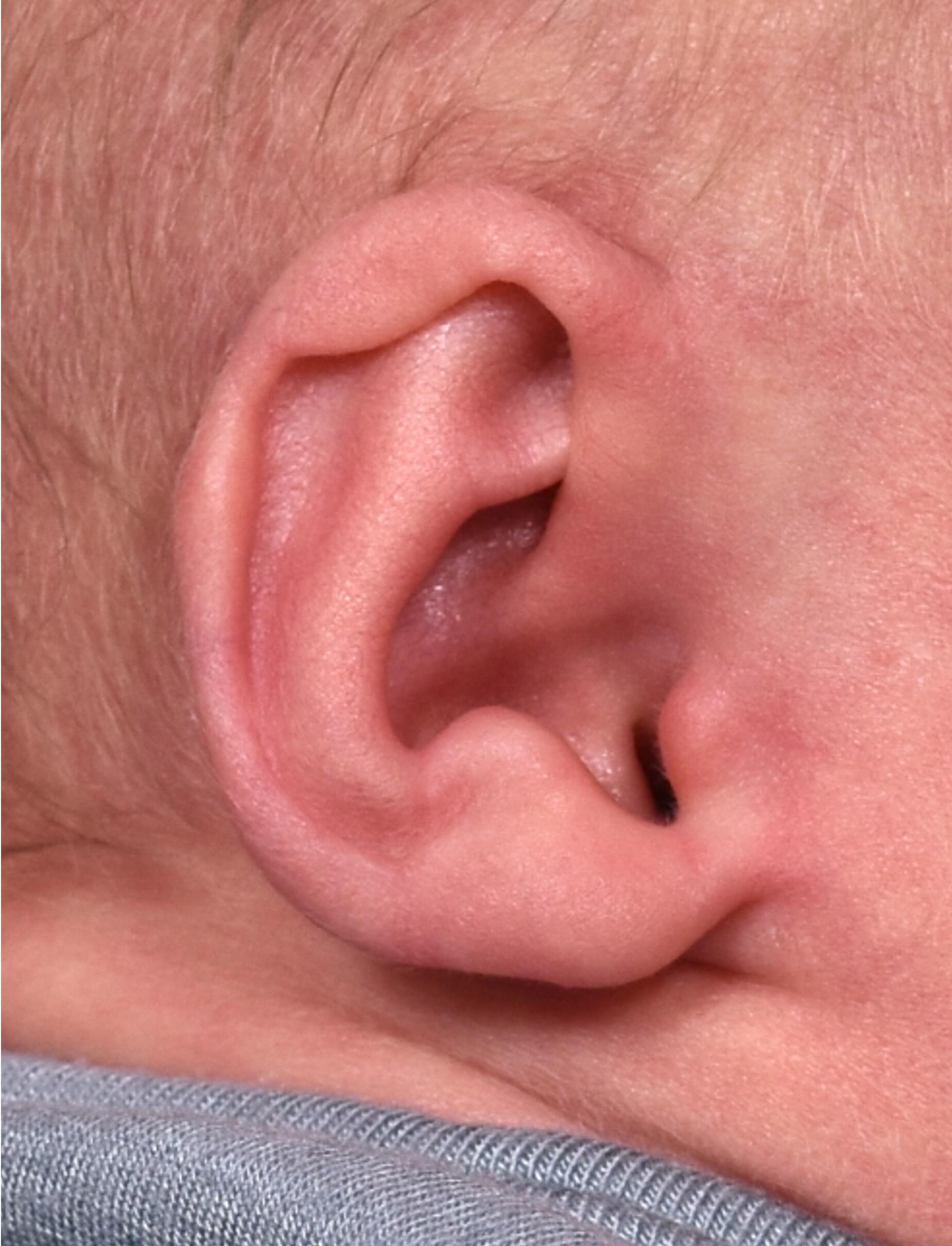 Aviva Plastic Surgery Earwell Atlanta baby ear treatment before and after