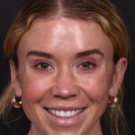 Aviva Plastic Surgery Atlanta Morpheus8 IPL before and after