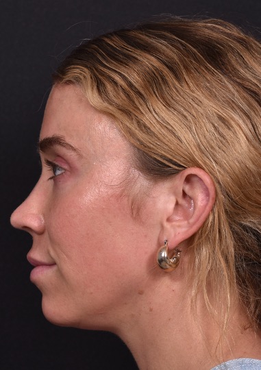 Aviva Plastic Surgery Atlanta Morpheus8 IPL before and after