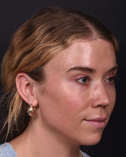 Aviva Plastic Surgery Atlanta Morpheus8 IPL before and after