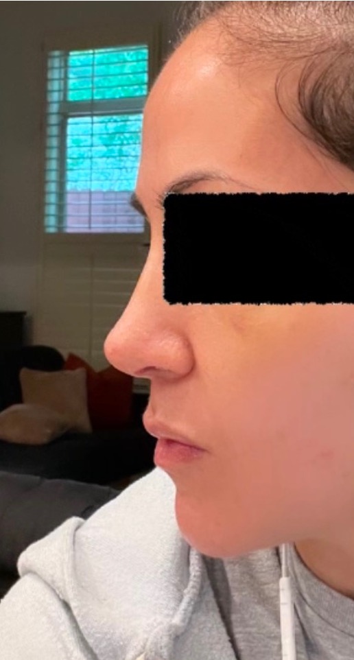 Rhinoplasty preservation Atlanta expert before and after