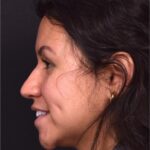 rhinoplasty expert specialist Atlanta preservation ultrasonic