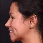 rhinoplasty expert specialist Atlanta preservation ultrasonic