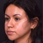 Aviva rhinoplasty best expert specialist before after Atlanta