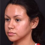 Aviva best rhinoplasty expert specialist before after nose job Atlanta