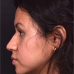 Aviva rhinoplasty specialist expert nose job before after best