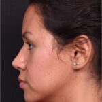 Aviva Atlanta rhinoplasty expert specialist before after nose job best