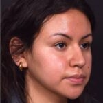 Aviva rhinoplasty Atlanta nose job expert specialist best before after
