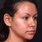 Aviva rhinoplasty Atlanta nose job expert specialist best before after