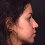 Aviva rhinoplasty Atlanta before after nose job expert specialist best surgeon