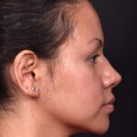 Aviva rhinoplasty Atlanta before after nose job expert specialist best surgeon