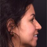 Aviva rhinoplasty Atlanta before after expert specialist nose job surgeon