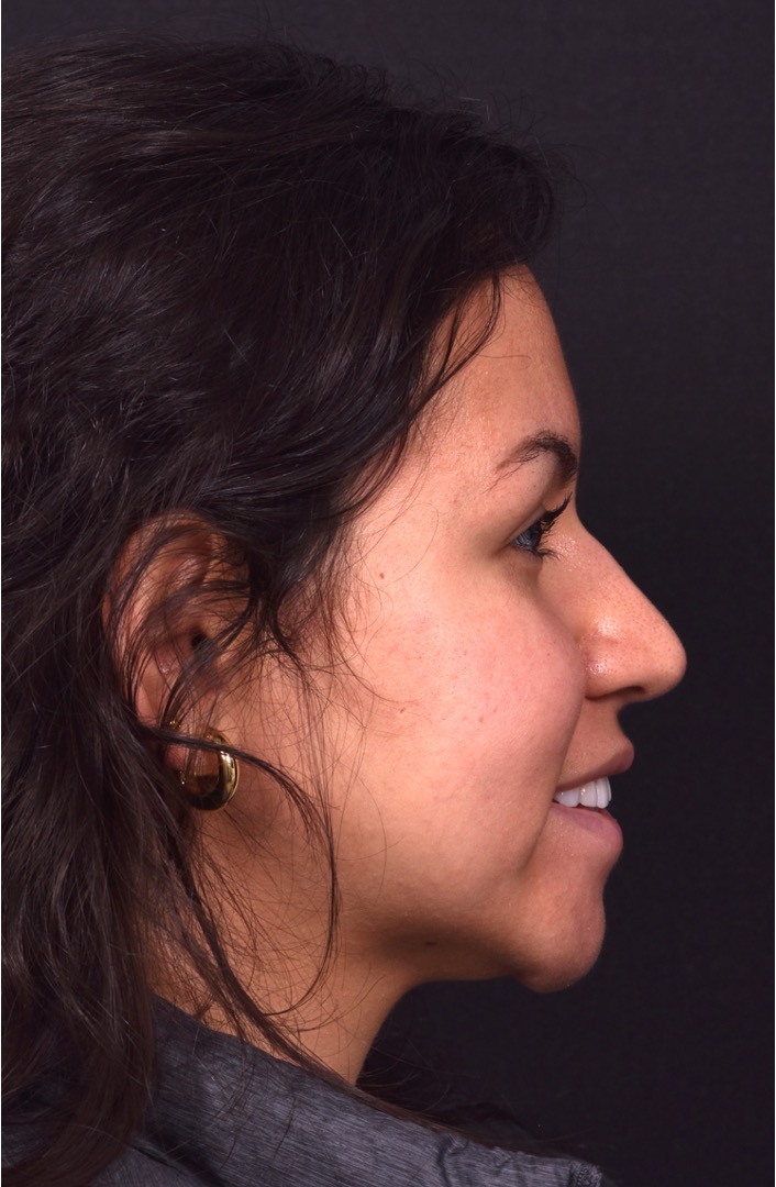 Aviva rhinoplasty Atlanta before after expert specialist nose job surgeon