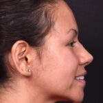 Aviva rhinoplasty Atlanta before after expert specialist nose job surgeon