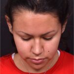Aviva rhinoplasty nose job expert specialist surgeon before after Atlanta