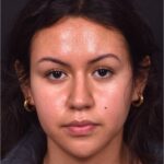 Aviva rhinoplasty Atlanta before after specialist preservation expert