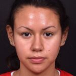 Aviva rhinoplasty Atlanta before after specialist preservation expert