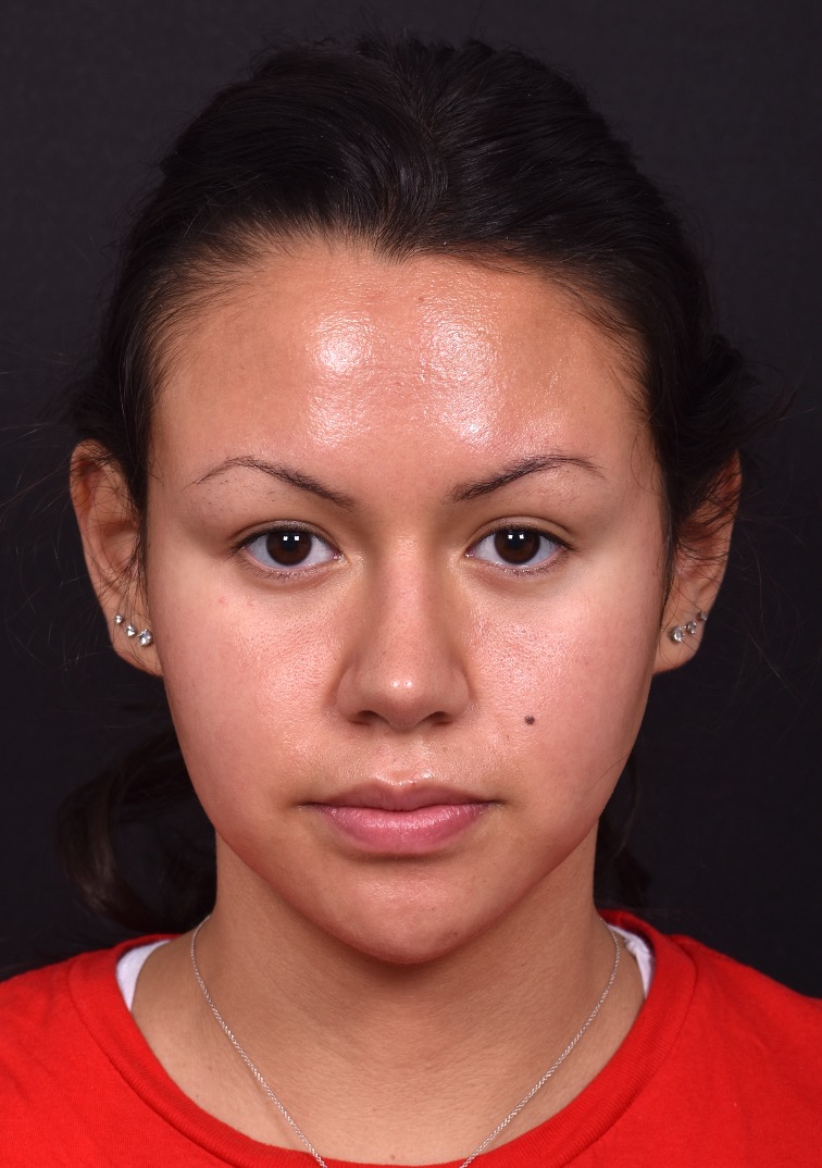 Aviva rhinoplasty Atlanta before after specialist preservation expert