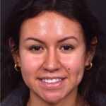 Aviva rhinoplasty expert Atlanta specialist surgeon nose job before after