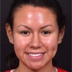 Aviva rhinoplasty expert Atlanta specialist surgeon nose job before after