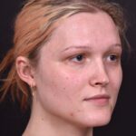 Lip filler Atlanta before and after expert best injector