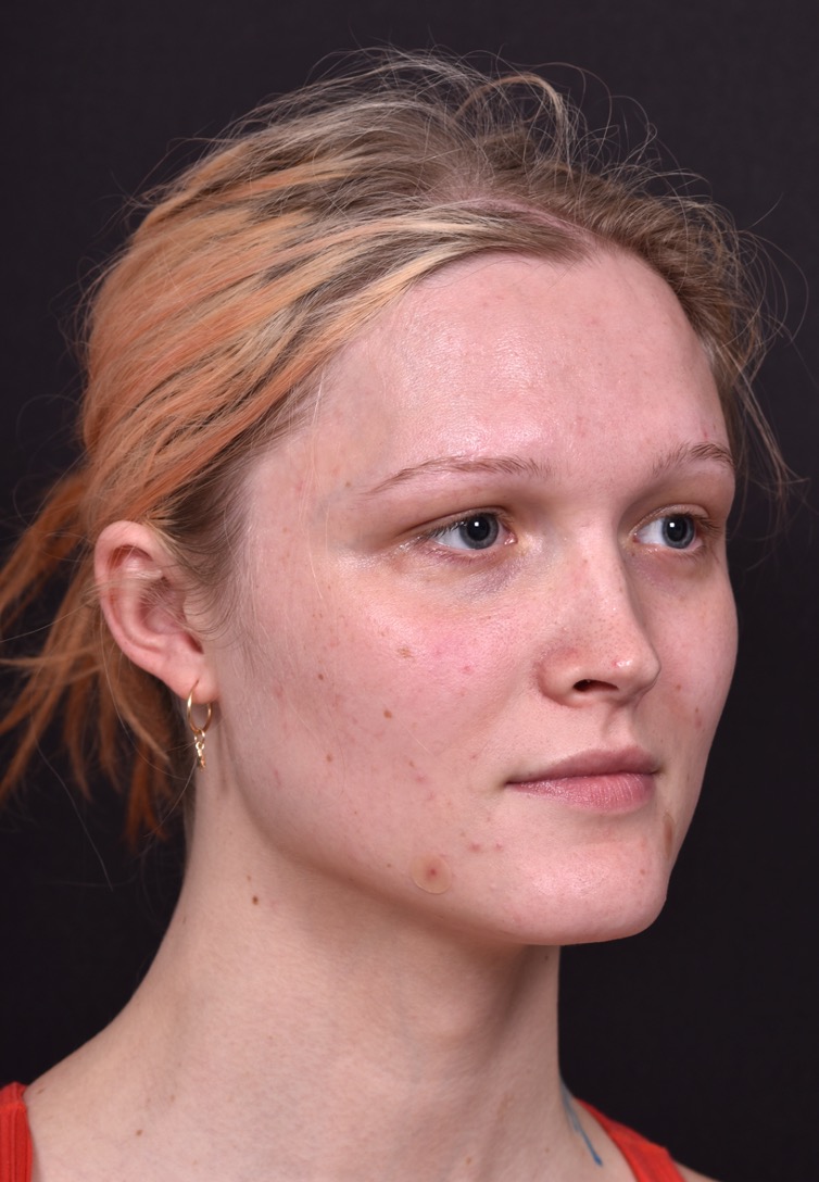 Lip filler Atlanta before and after expert best injector