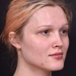 Lip filler Atlanta before and after expert best injector