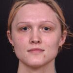 Lip filler Atlanta before and after expert best injector