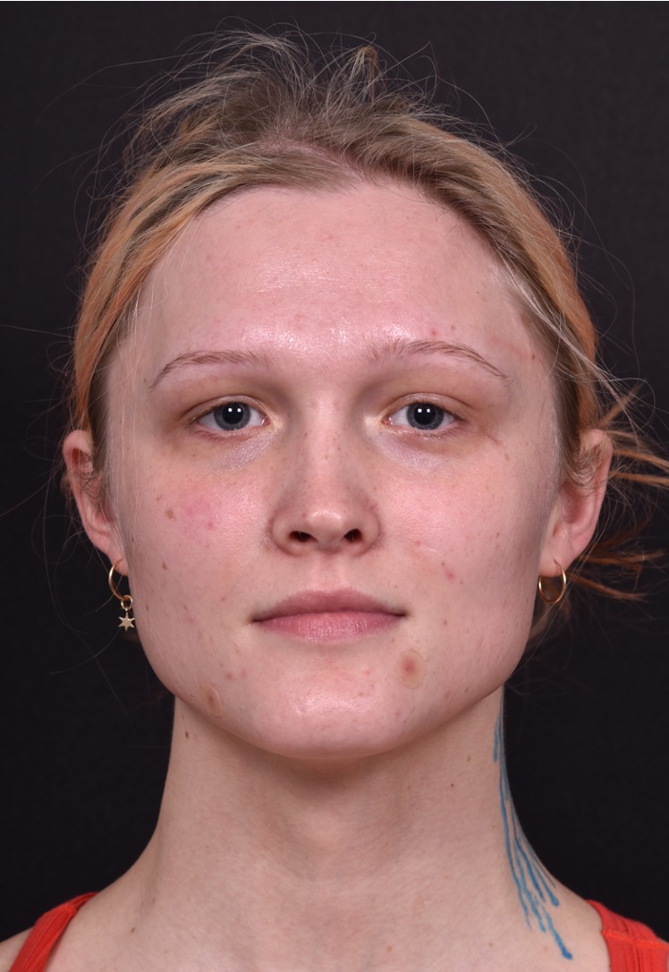 Lip filler Atlanta before and after expert best injector