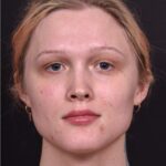 Lip filler Atlanta before and after expert best injector