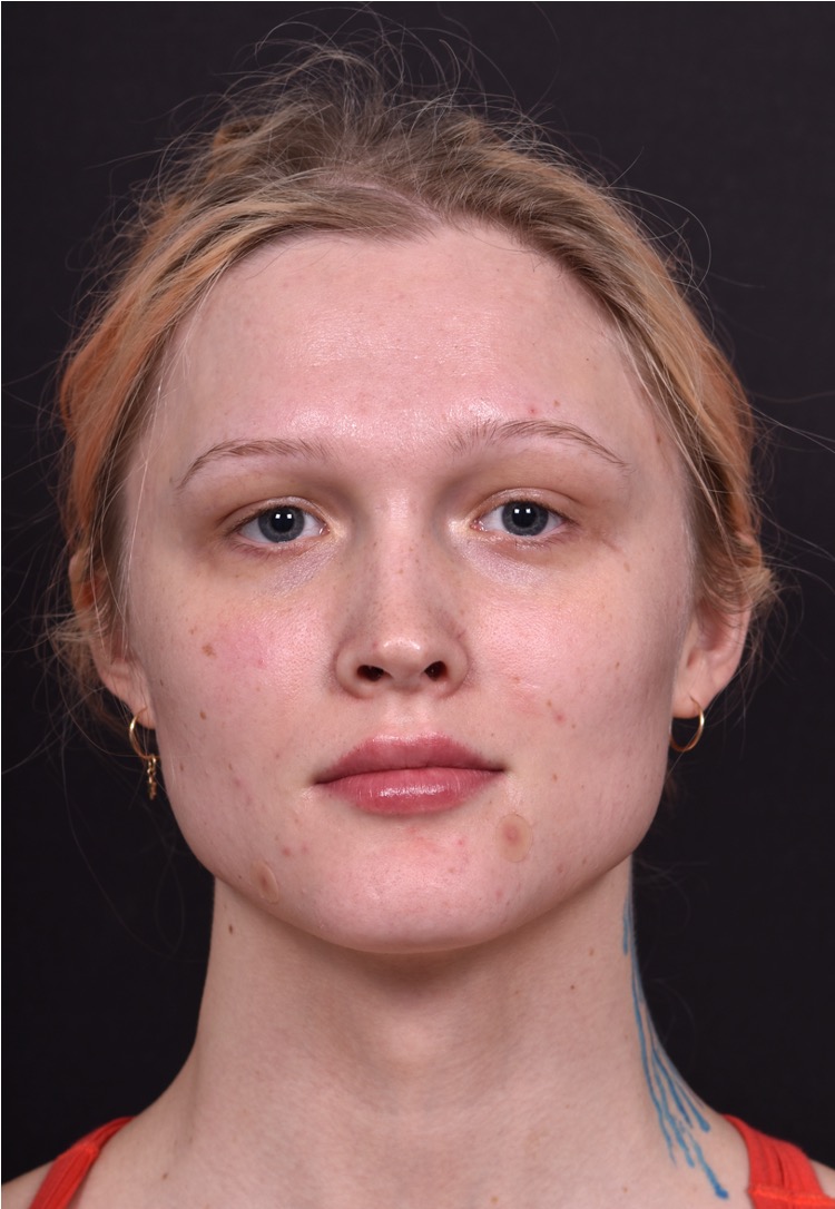 Lip filler Atlanta before and after expert best injector