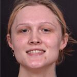 Lip filler Atlanta before and after expert best injector