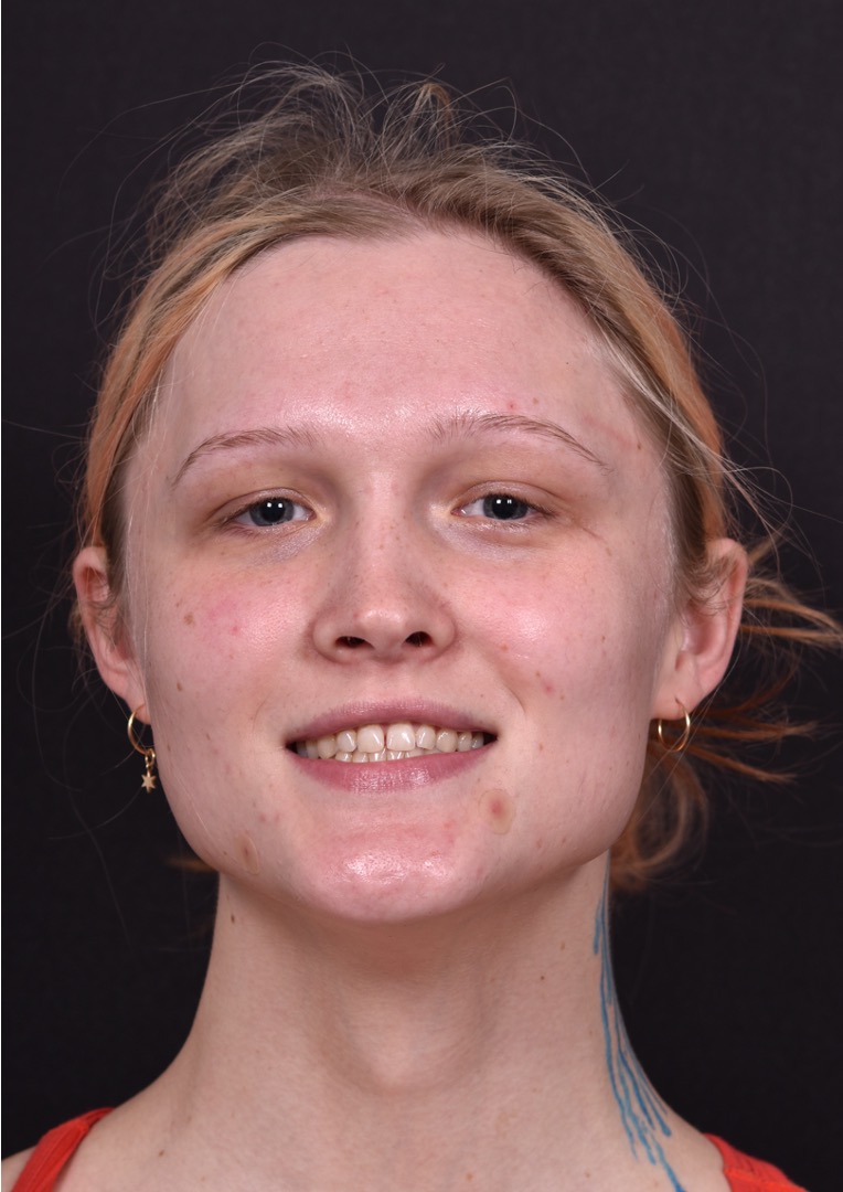 Lip filler Atlanta before and after expert best injector