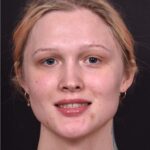 Lip filler Atlanta before and after expert best injector