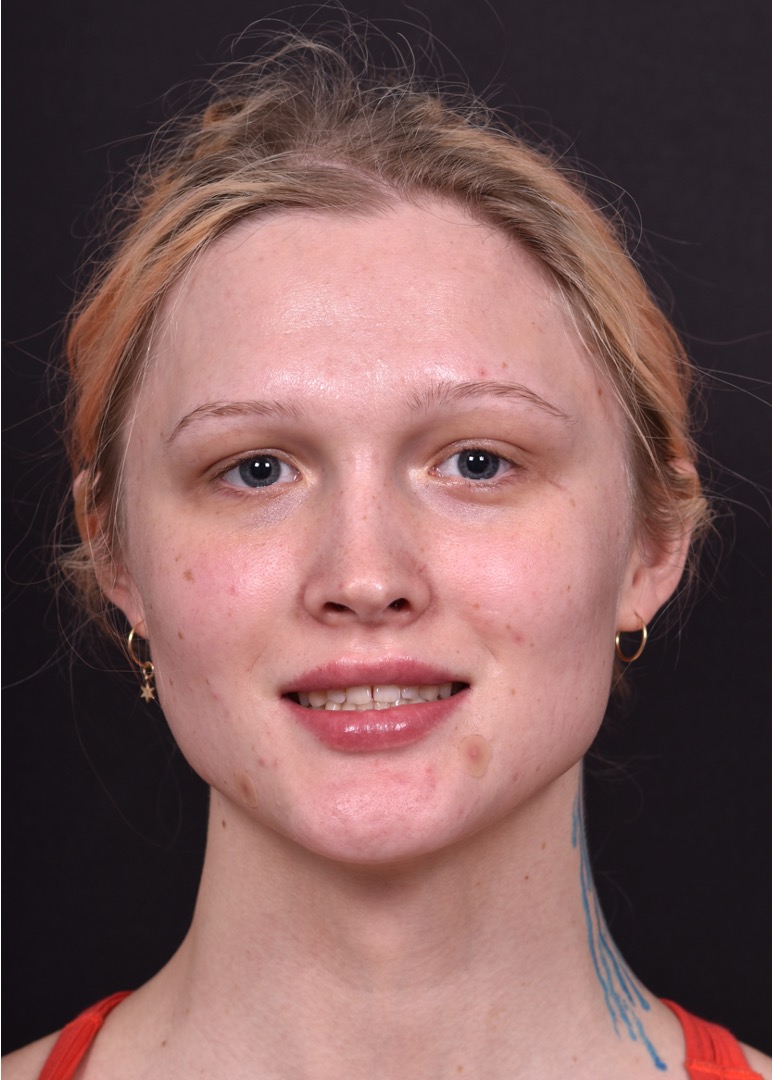 Lip filler Atlanta before and after expert best injector