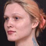 Lip filler Atlanta before and after expert best injector