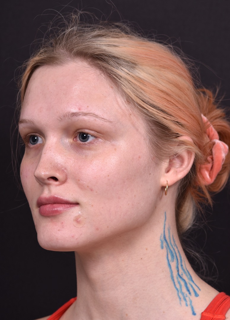 Lip filler Atlanta before and after expert best injector