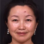 Atlanta hemagioma skin before and after best expert plastic surgeon