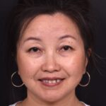 Atlanta hemagioma skin before and after best expert plastic surgeon