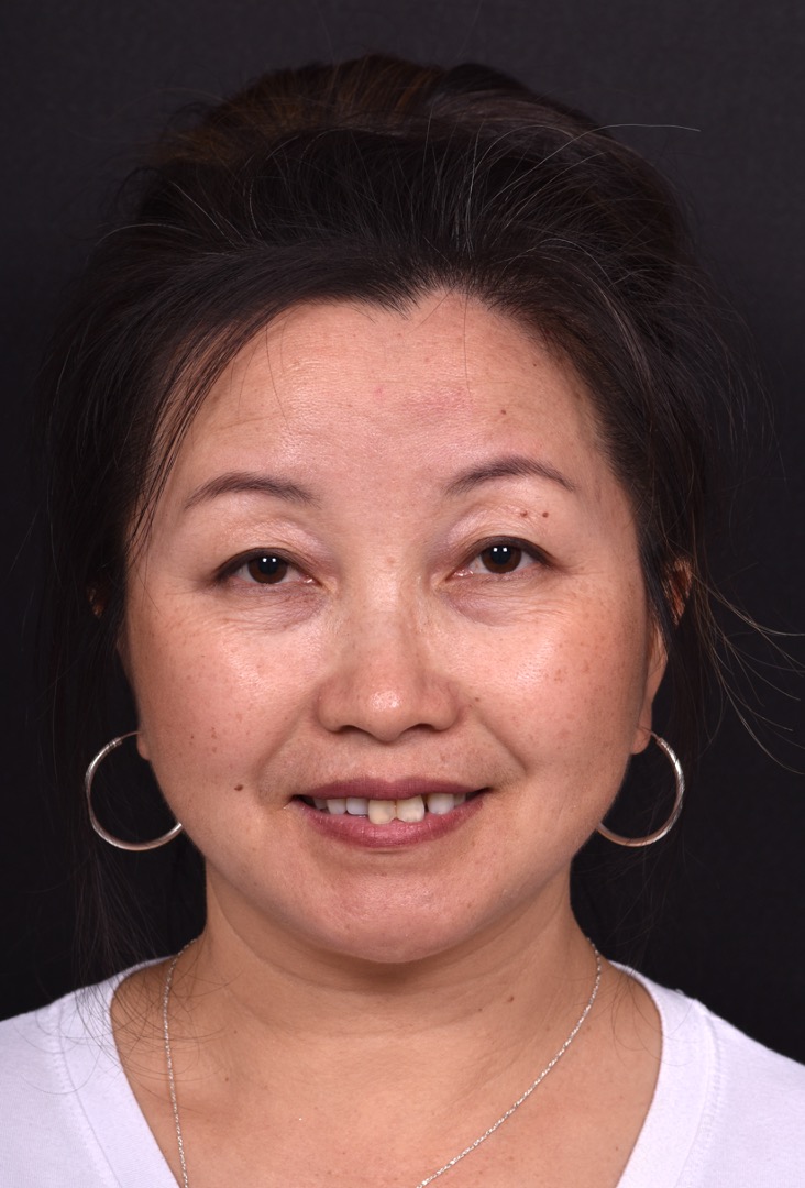 Atlanta hemagioma skin before and after best expert plastic surgeon