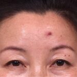 Atlanta hemagioma skin before and after best expert plastic surgeon