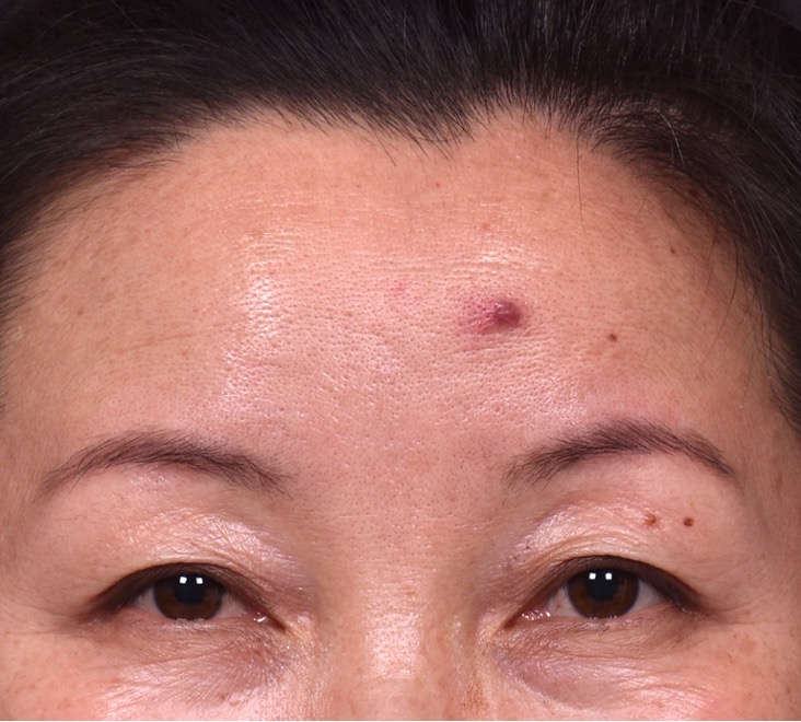 Atlanta hemagioma skin before and after best expert plastic surgeon