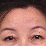 Atlanta hemagioma skin before and after best expert plastic surgeon