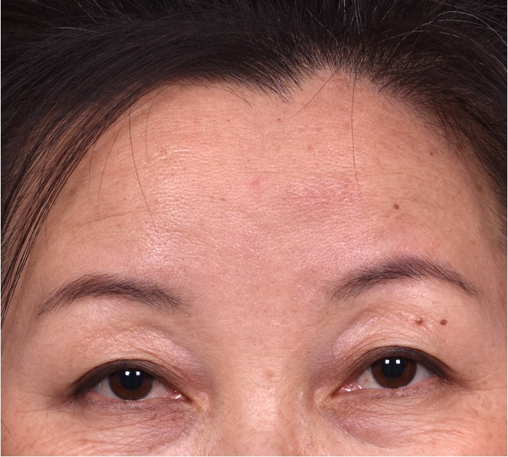 Atlanta hemagioma skin before and after best expert plastic surgeon