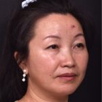 Atlanta hemagioma skin before and after best expert plastic surgeon