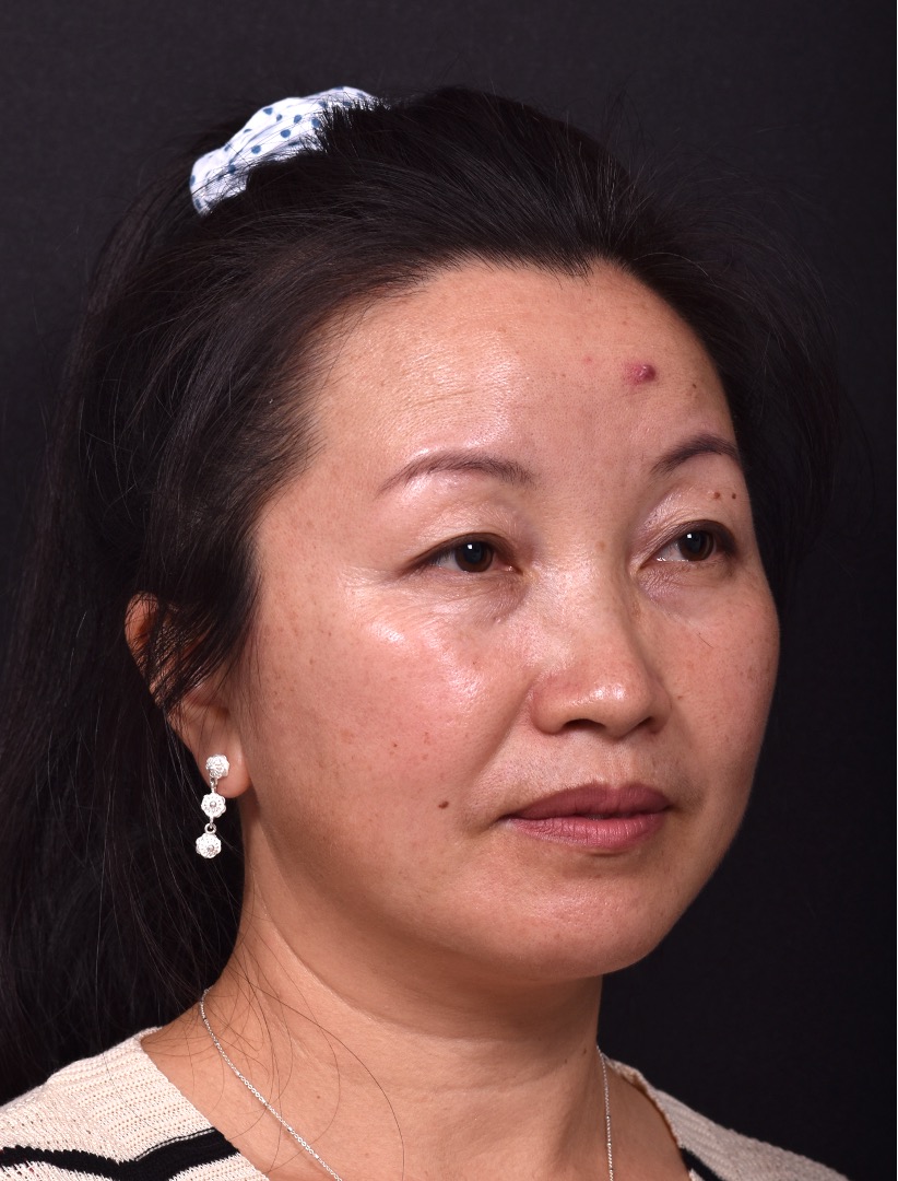 Atlanta hemagioma skin before and after best expert plastic surgeon