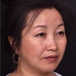 Atlanta hemagioma before after best expert plastic surgeon