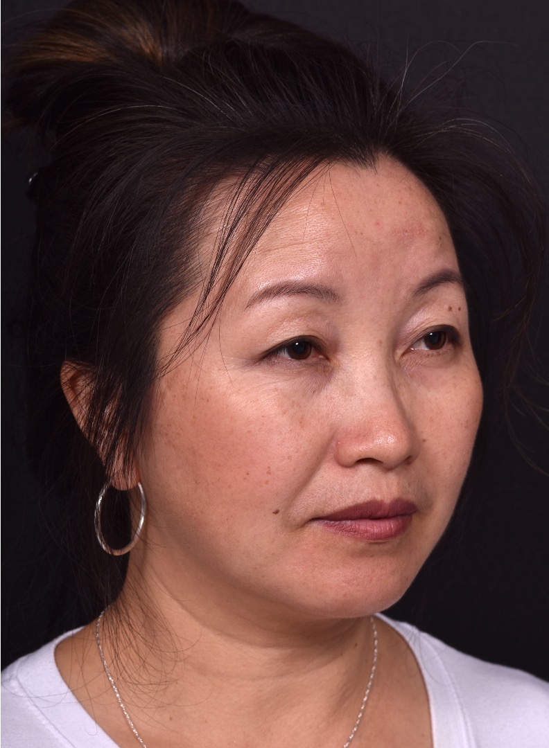 Atlanta hemagioma before after best expert plastic surgeon