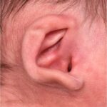 Earwell newborn baby ear treatment otoplasty best